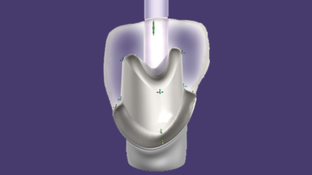 Custom Abutments