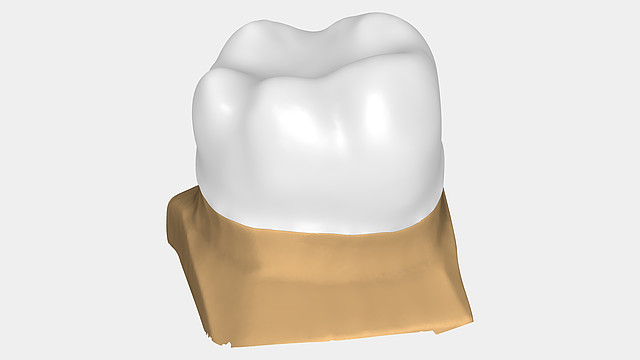 Anatomic Copings