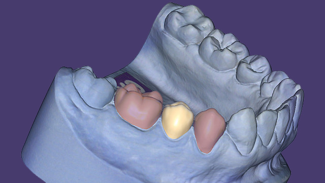 Temporary Crowns & Bridges