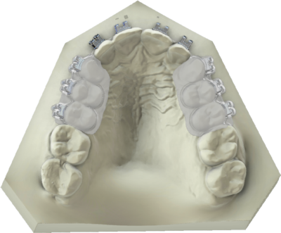 Clear Aligner Brackets Tray 1