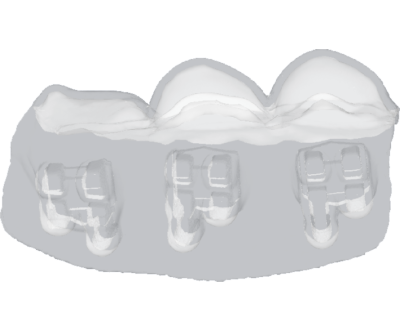 Clear Aligner Brackets Tray 2