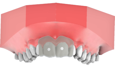 Attachment Tray 1