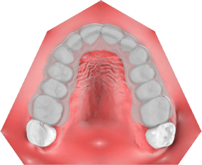 Clear Aligner 1