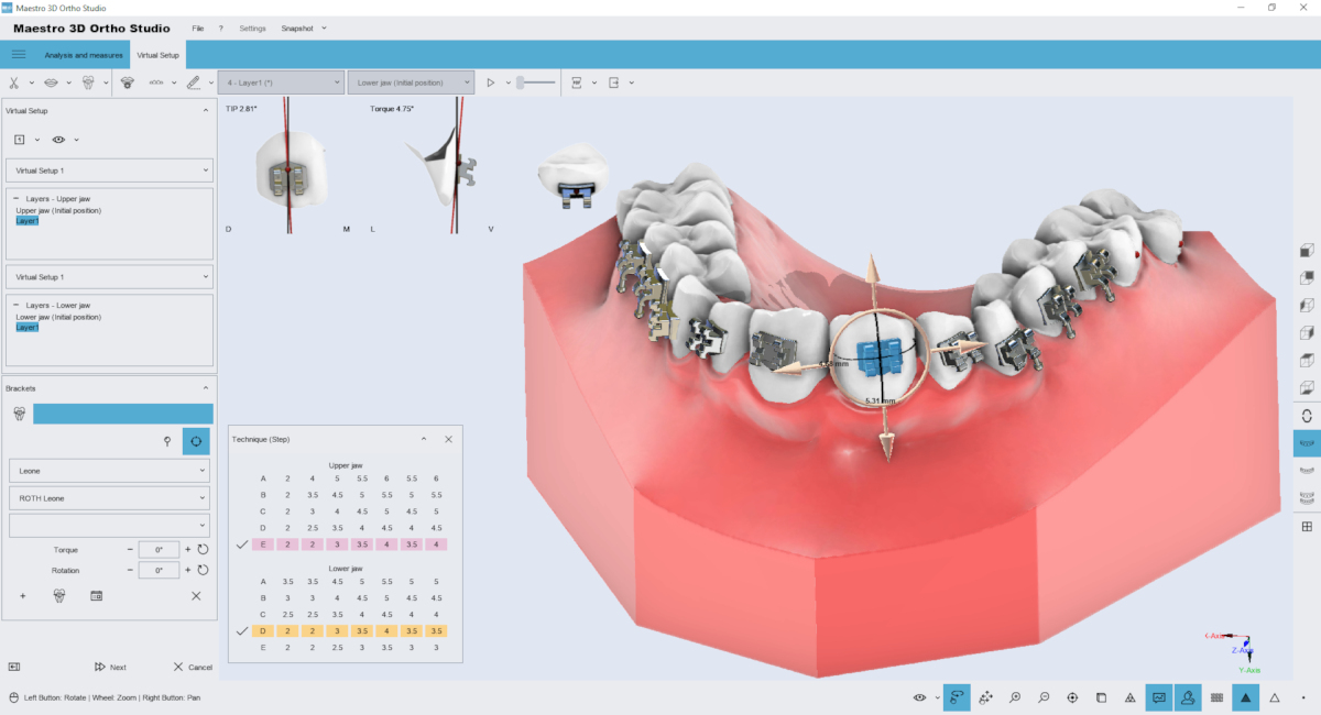 Brackets Placement